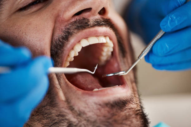 Best Emergency Broken Tooth Repair in Picayune, MS