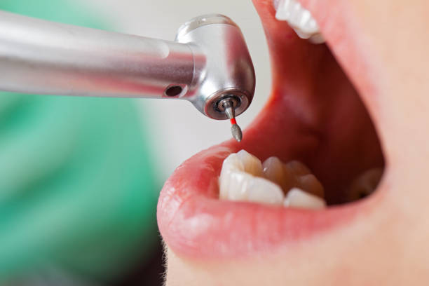 Best Emergency Tooth Extraction in Picayune, MS